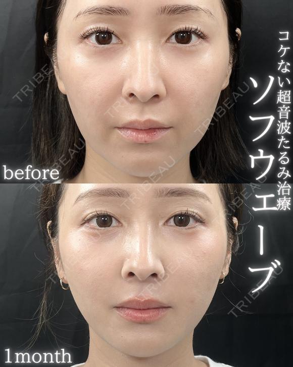 ソフウェーブ before画像 メイン用