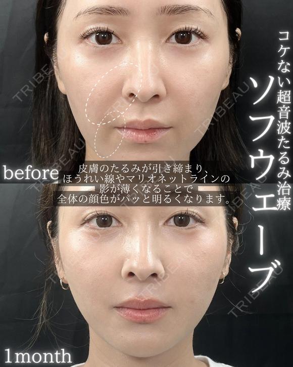 ソフウェーブ 30日後 メイン用