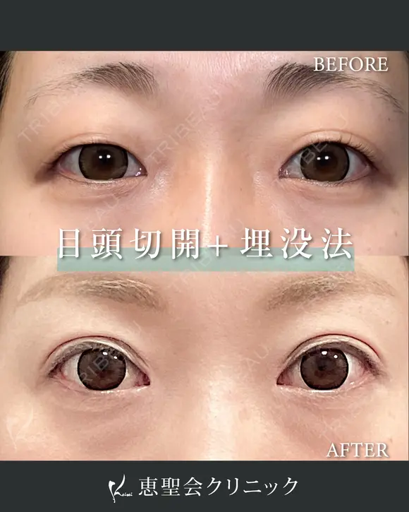 MT埋没法 3点留め+目頭切開 before画像 メイン用