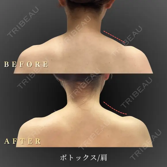 肩ボトックス 60日後 メイン用