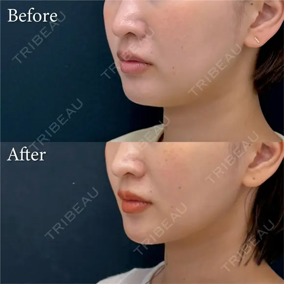 脂肪吸引注射 after画像 メイン用