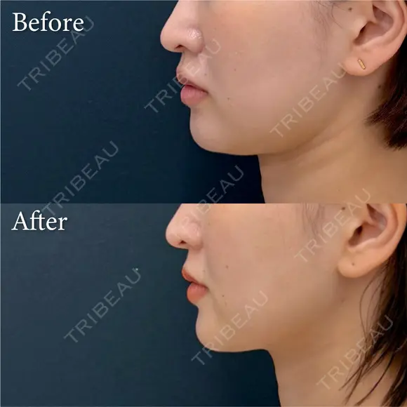 脂肪吸引注射 after画像 メイン用