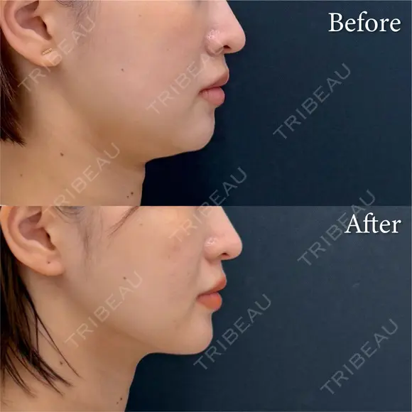脂肪吸引注射 after画像 メイン用