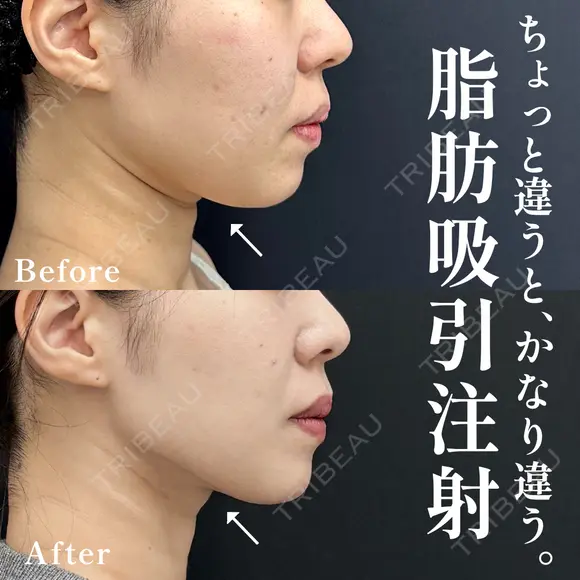 脂肪吸引注射 after画像 メイン用