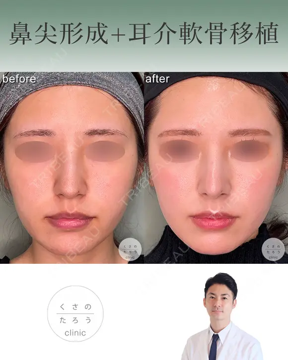 鼻尖形成+耳介軟骨移植 after画像 メイン用