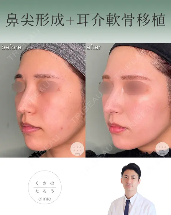 鼻尖形成+耳介軟骨移植 after画像 メイン用