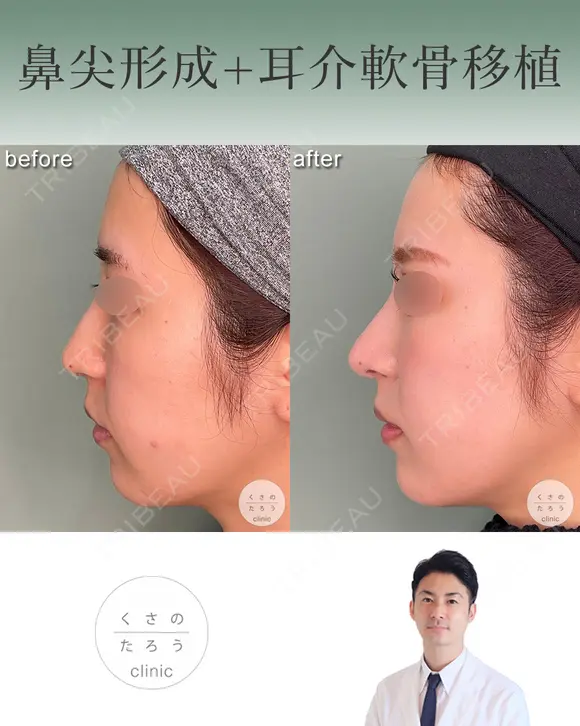 鼻尖形成+耳介軟骨移植 after画像 メイン用