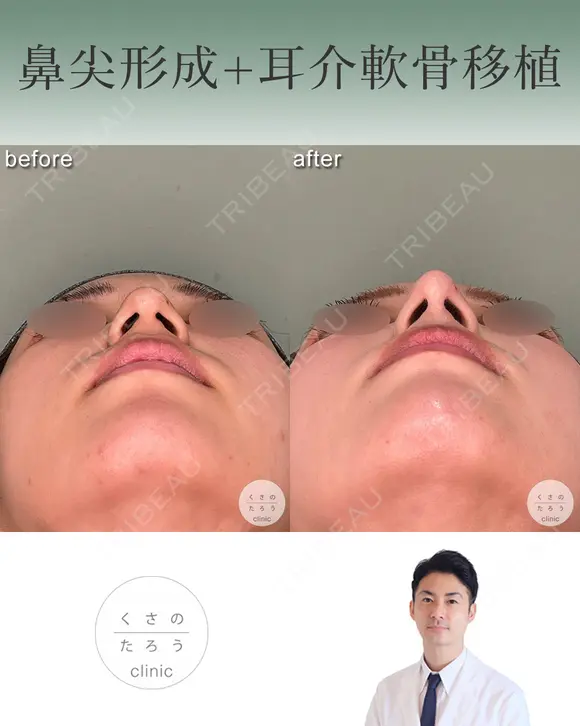 鼻尖形成+耳介軟骨移植 after画像 メイン用