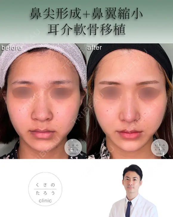 鼻尖形成+耳介軟骨移植+鼻翼縮小 after画像 メイン用