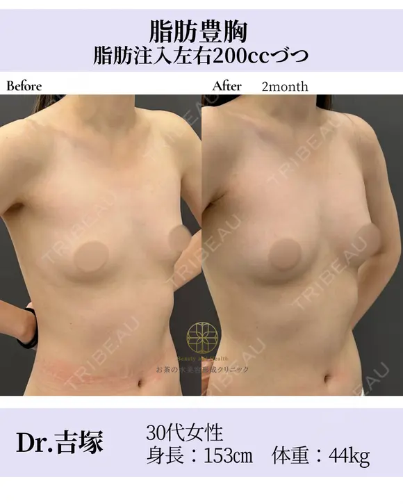 脂肪豊胸 after画像 メイン用