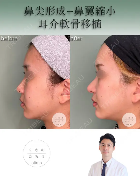 鼻尖形成+耳介軟骨移植+鼻翼縮小 after画像 メイン用