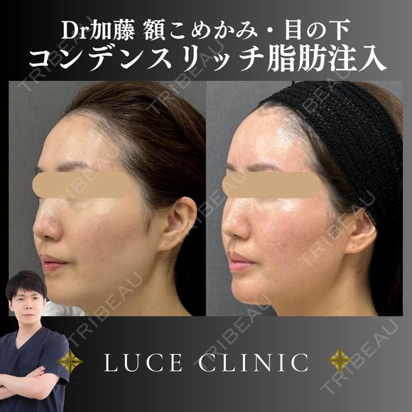コンデンスリッチ脂肪注入 after画像 メイン用