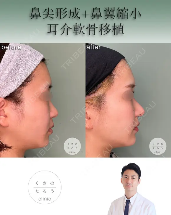鼻尖形成+耳介軟骨移植+鼻翼縮小 after画像 メイン用