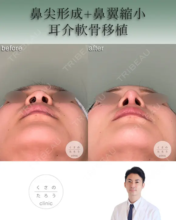 鼻尖形成+耳介軟骨移植+鼻翼縮小 after画像 メイン用