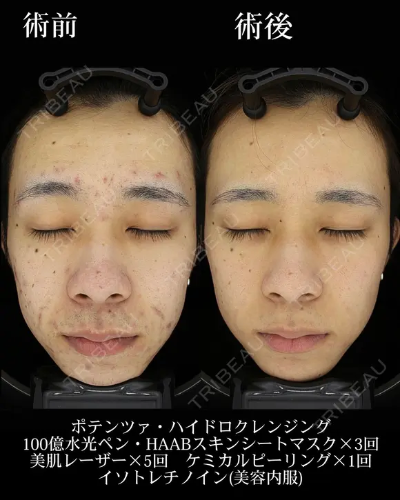 ポテンツァ/ハイドロクレンジング/100億水光ペン/HAABスキンシートマスク/美肌レーザー/ケミカルピーリング/イソトレチノイン 225日後 メイン用