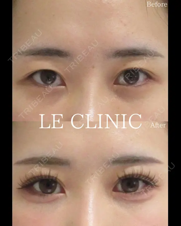 二重埋没 before画像 メイン用