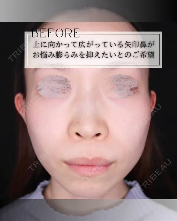 鼻翼縮小 before画像 メイン用