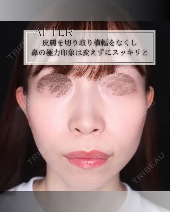 鼻翼縮小 after画像 メイン用