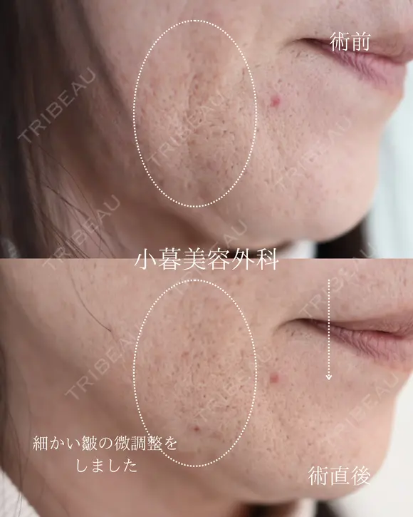 法令線ヒアルロン酸 before画像 メイン用