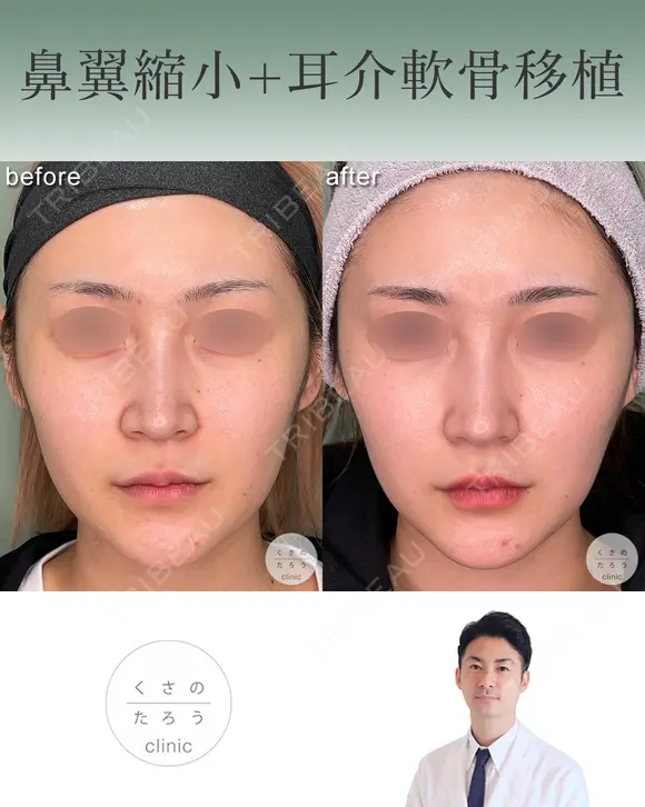 鼻翼縮小＋耳介軟骨移植 after画像 メイン用