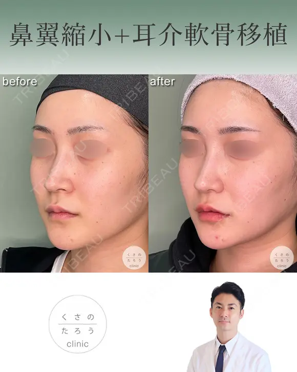 鼻翼縮小＋耳介軟骨移植 after画像 メイン用
