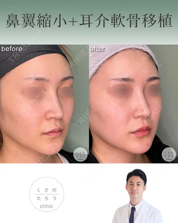 鼻翼縮小＋耳介軟骨移植 after画像 メイン用