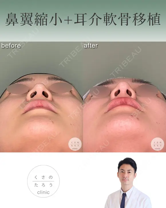 鼻翼縮小＋耳介軟骨移植 after画像 メイン用