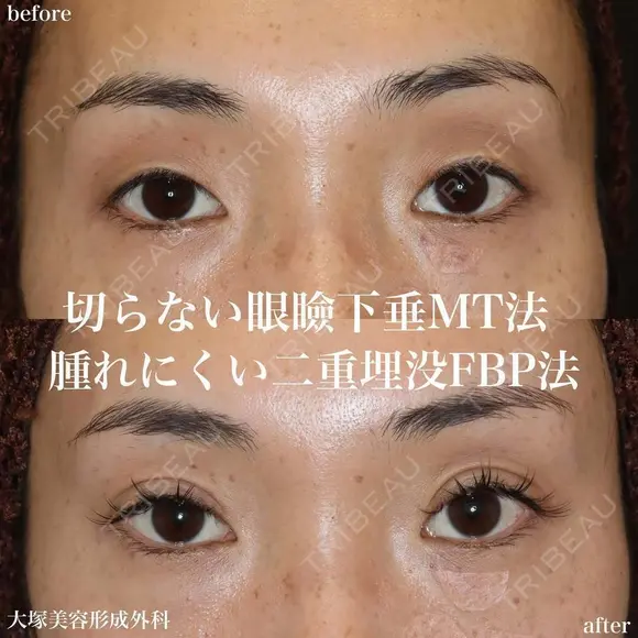 切らない眼瞼下垂MT法+腫れにくい二重埋没FBP法 after画像 メイン用