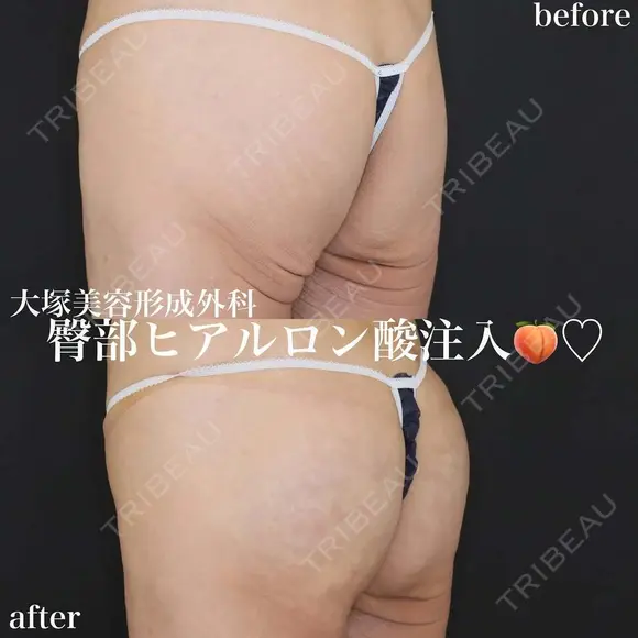 臀部ヒアルロン酸注入 before画像 メイン用