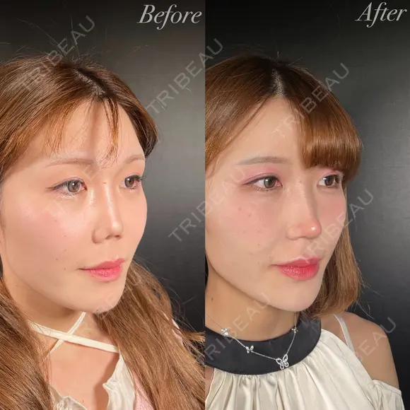 鼻整形－複合－ before画像 メイン用