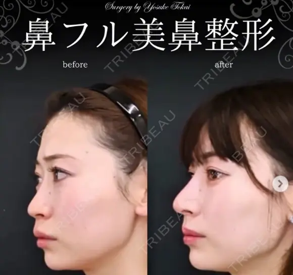 鼻フル（隆鼻術プロテーゼ・鼻中隔延長術・鼻尖形成・鼻先軟骨移植・鼻柱軟骨移植） after画像 メイン用