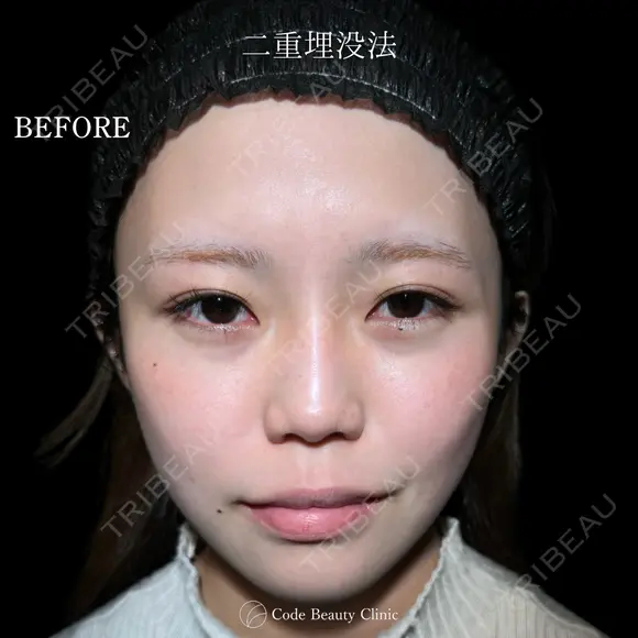 二重埋没法 before画像 メイン用