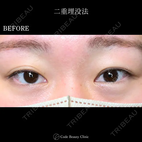 二重埋没法 before画像 メイン用
