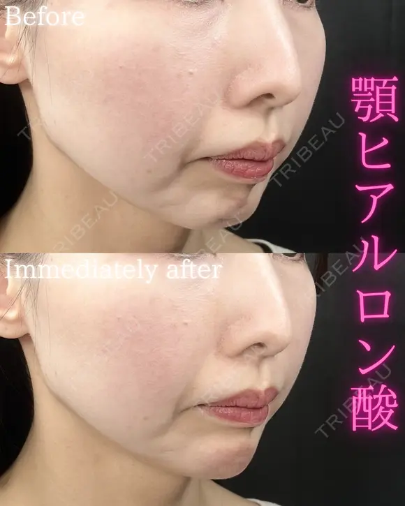 顎ヒアルロン酸 before画像 メイン用