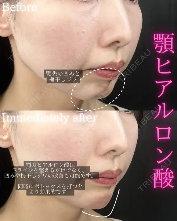 顎ヒアルロン酸 after画像 メイン用
