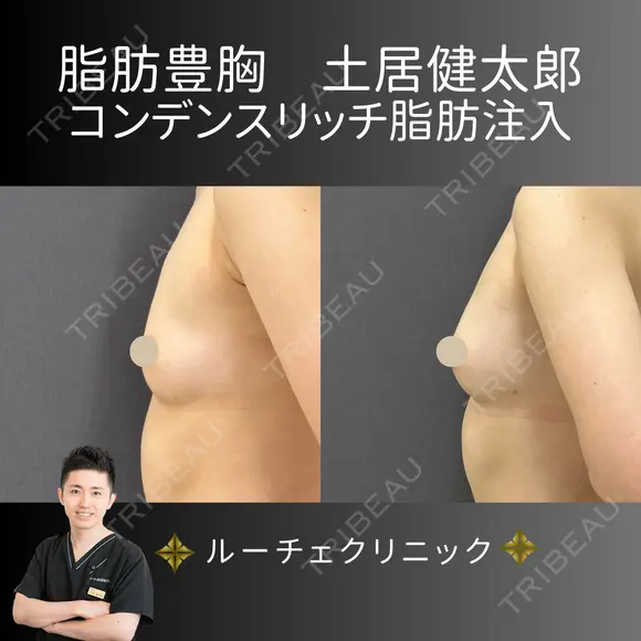 コンデンスリッチ脂肪豊胸 after画像 メイン用