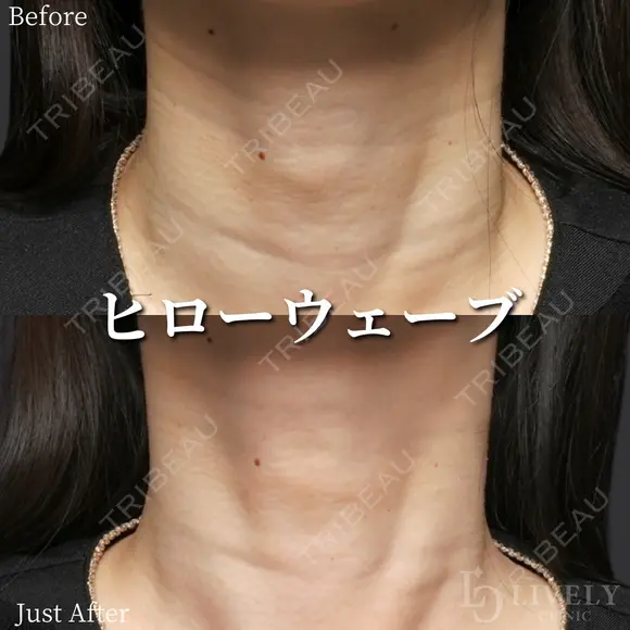 ヒローウェーブ(首のヒアルロン酸) after画像 メイン用