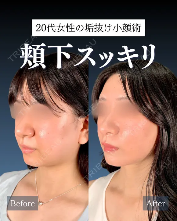 岩﨑先生による🔥小顔整形🔥 after画像 メイン用