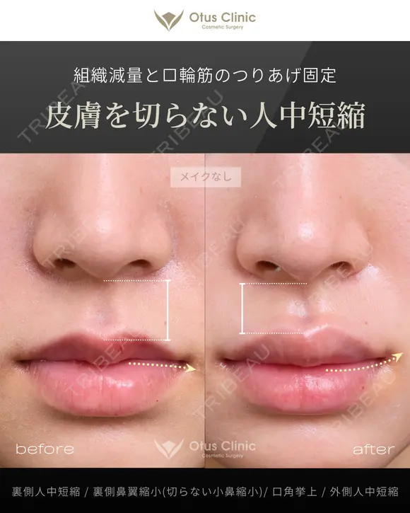裏側人中短縮（口腔内人中短縮）・裏側鼻翼縮小（切らない鼻翼縮小）・口角挙上・外側人中短縮 90日後 メイン用