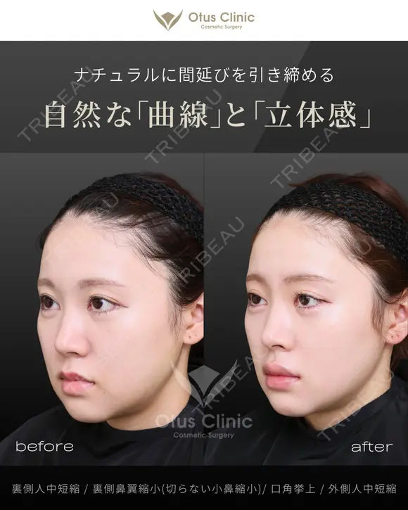 裏側人中短縮（口腔内人中短縮）・裏側鼻翼縮小（切らない鼻翼縮小）・口角挙上・外側人中短縮 before画像 メイン用