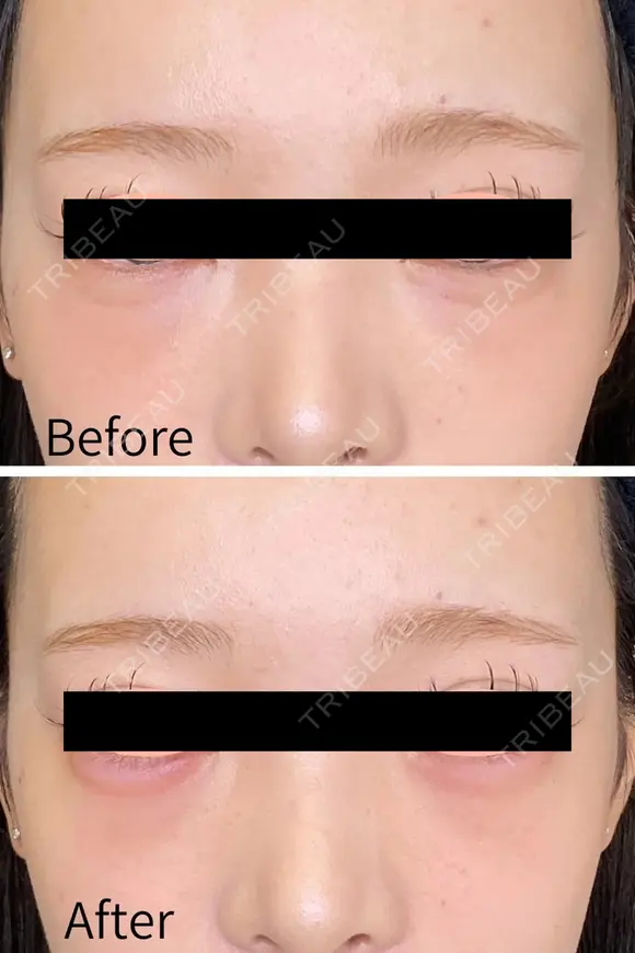涙袋ヒアルロン酸 before画像 メイン用