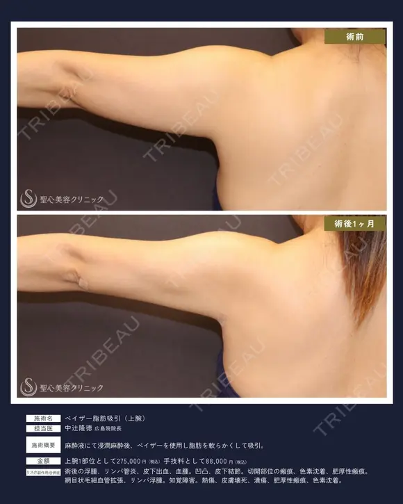 【40代女性・スッキリ二の腕】ベイザー脂肪吸引 上腕（二の腕）（1ヶ月） 30日後 メイン用
