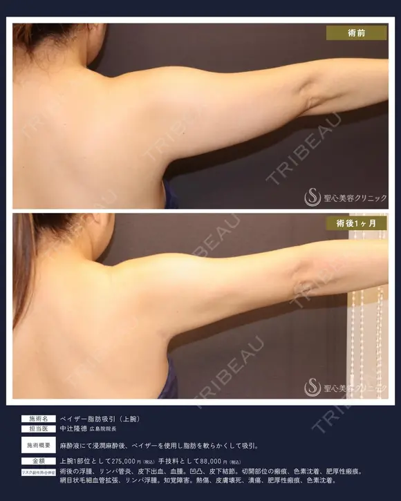 【40代女性・スッキリ二の腕】ベイザー脂肪吸引 上腕（二の腕）（1ヶ月） 30日後 メイン用