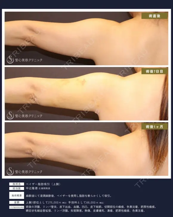 【40代女性・スッキリ二の腕】ベイザー脂肪吸引 上腕（二の腕）（1ヶ月） 30日後 メイン用