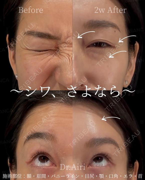 ボトックス after画像 メイン用