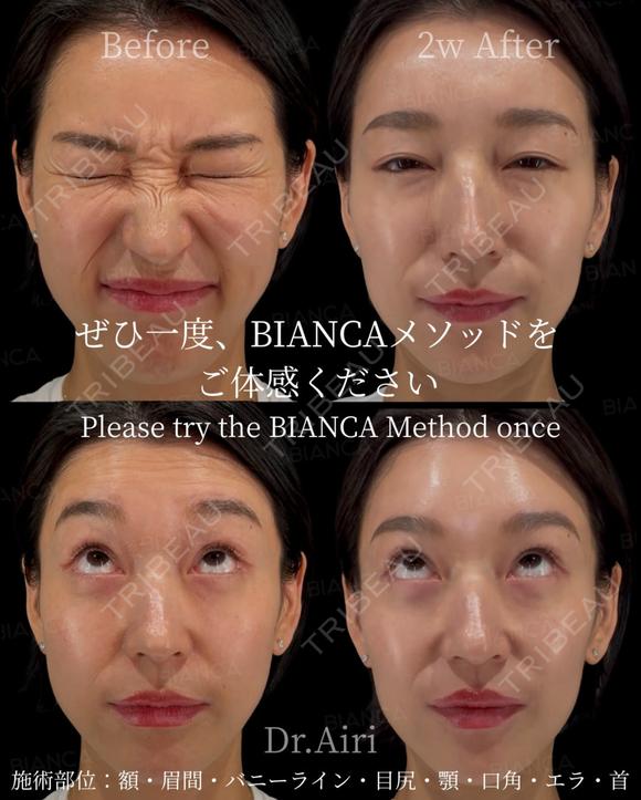 ボトックス after画像 メイン用