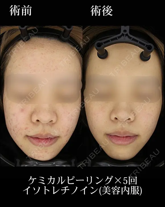 ケミカルピーリング/イソトレチノイン(美容内服) before画像 メイン用