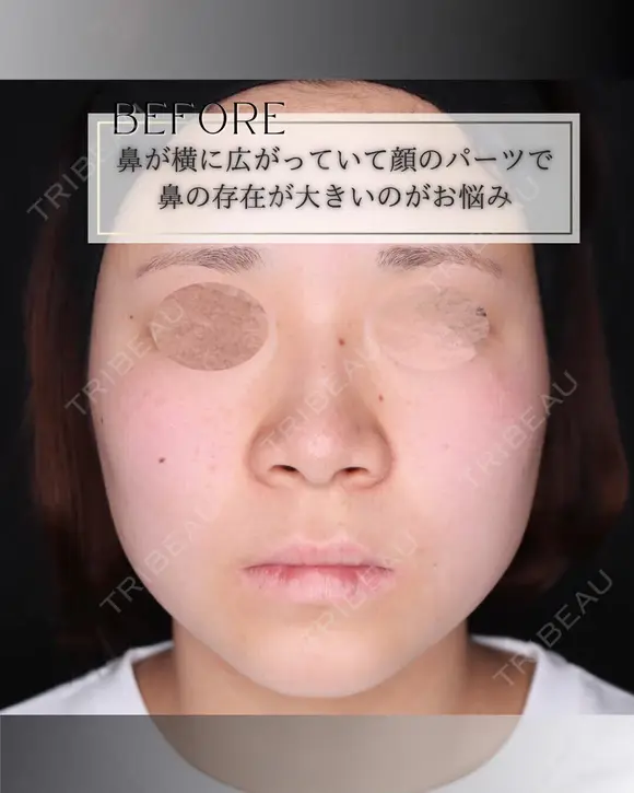 小鼻縮小 before画像 メイン用