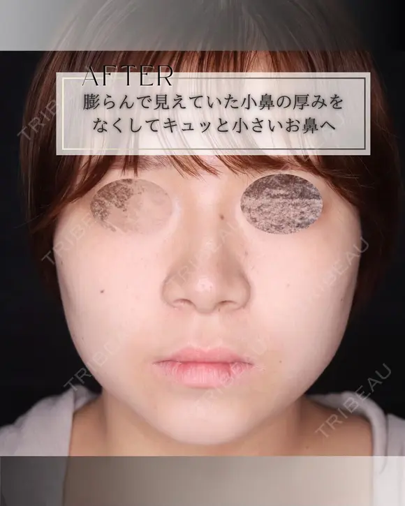小鼻縮小 after画像 メイン用