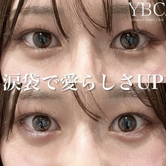 【涙袋ヒアルロン酸で可愛らしさアップ💗】 before画像 メイン用